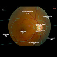 Load image into Gallery viewer, Software Artificial Inteligence, , Huvitz Med® - Fundus AI™ Huvitz Software Artificial Inteligence | US Ophthalmic, US Ophthalmic | Ophthalmology & Optometry Equipment for sale