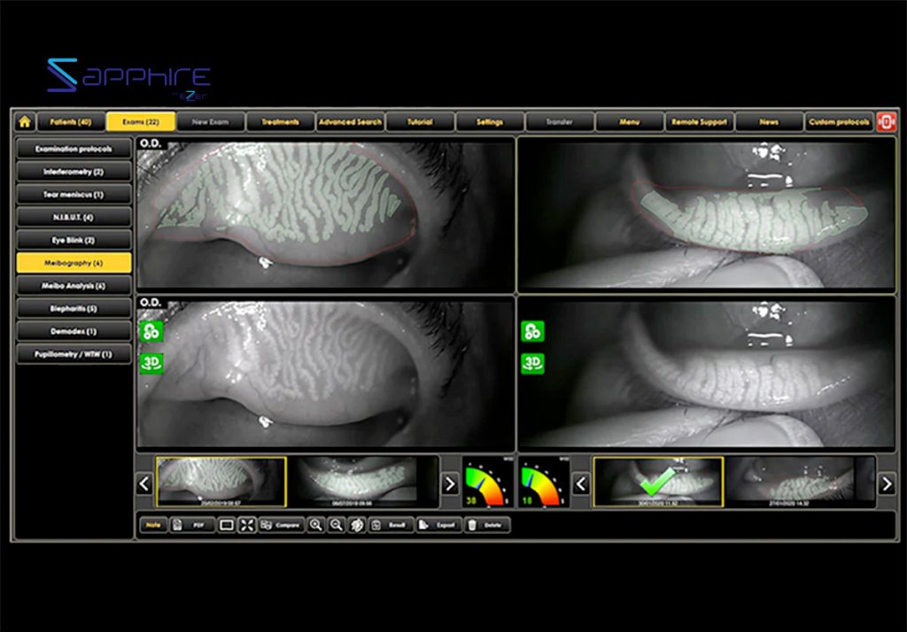 Ezer Dry Eye Sapphire A – image 11