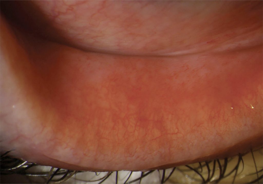 Ezer Dry Eye Sapphire A – image 17