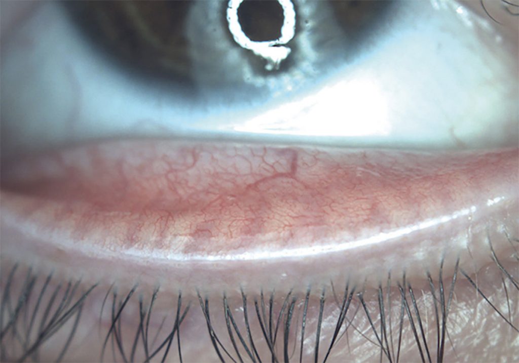 Ezer Dry Eye Sapphire A – image 18
