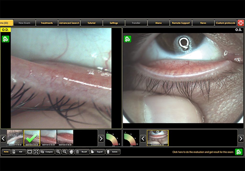 Ezer Dry Eye Sapphire A – image 20
