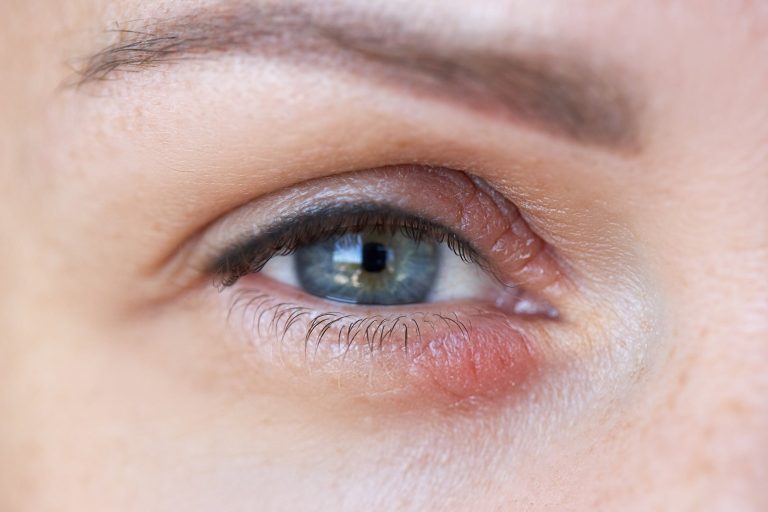 Eyelid lesions
