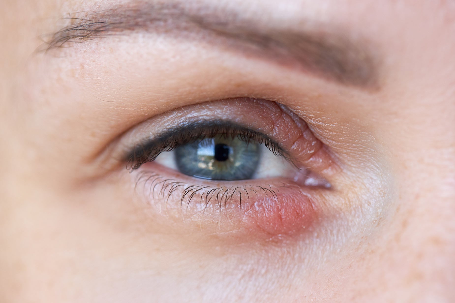 Eyelid lesions