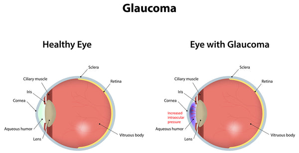 glaucoma
