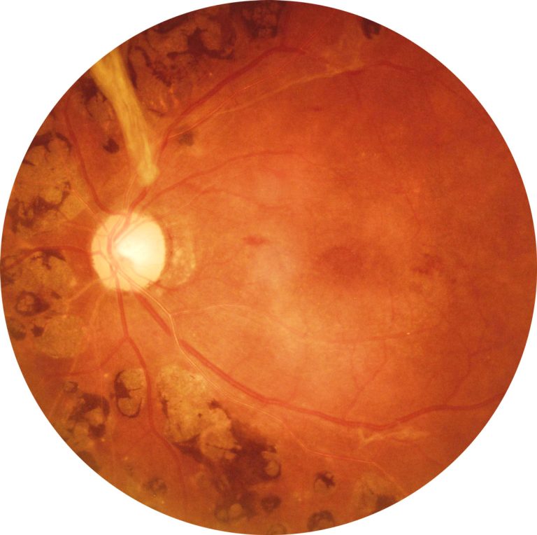 retinopatia diabetica